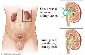 Kidney Stone Removal Treatment