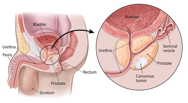 Prostate Surgery